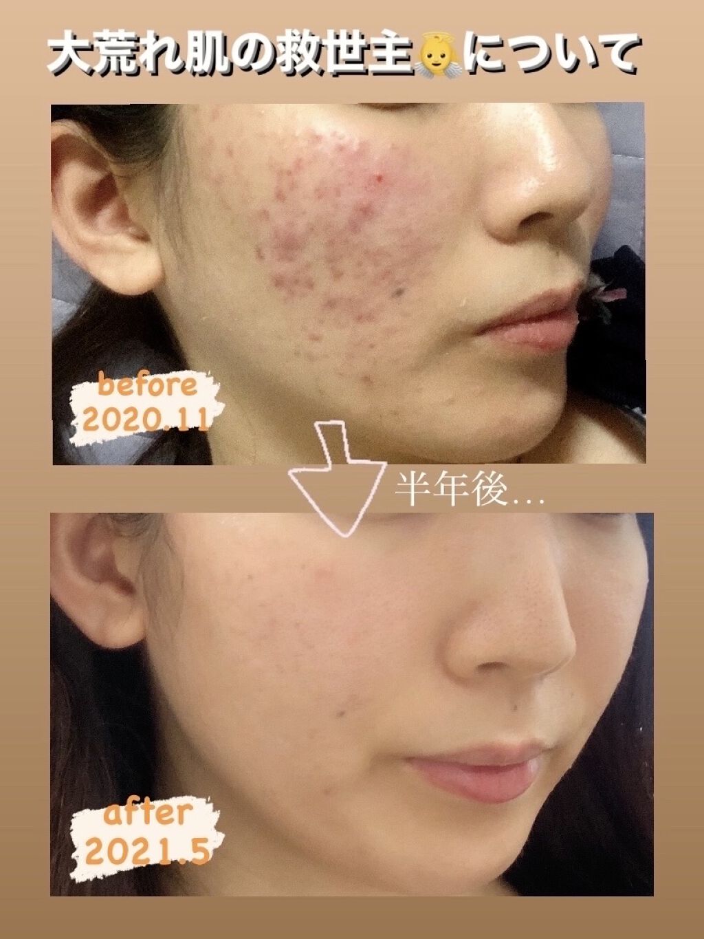 スキンケア方法 ロゼット 洗顔パスタ 荒性肌 ロゼットの使い方 効果 汚肌写真失礼いた By Lili 混合肌 代前半 Lips