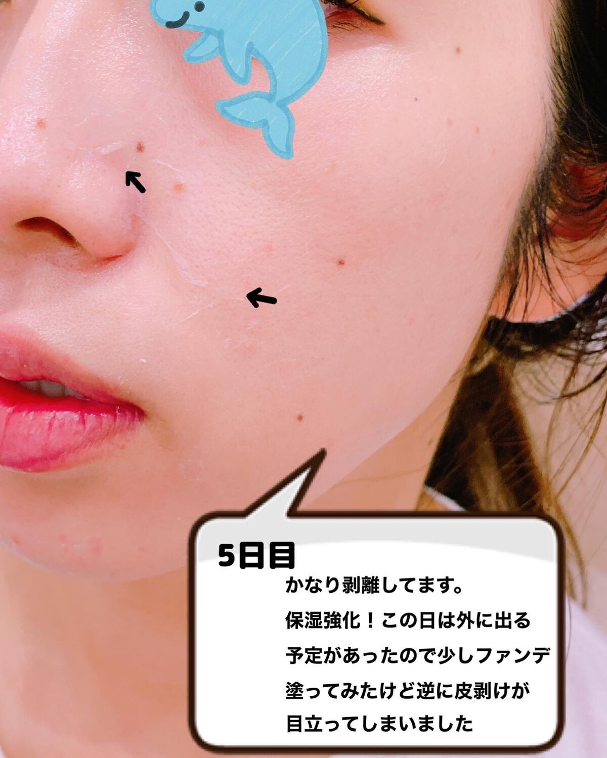 ダーマスキンピーリング/BQCELL/その他キットセットを使ったクチコミ(6枚目)