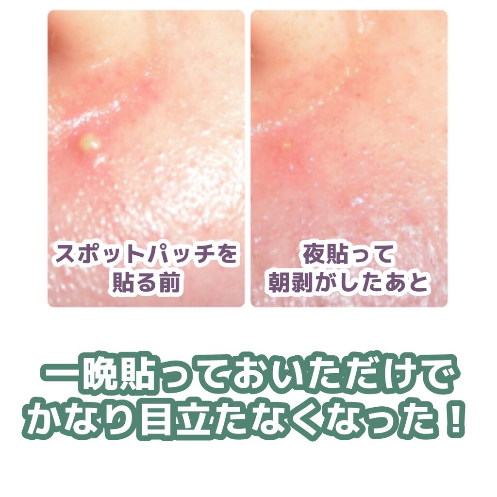 プロCICA クリアスポットパッチ/VT/その他スキンケアを使ったクチコミ（3枚目）