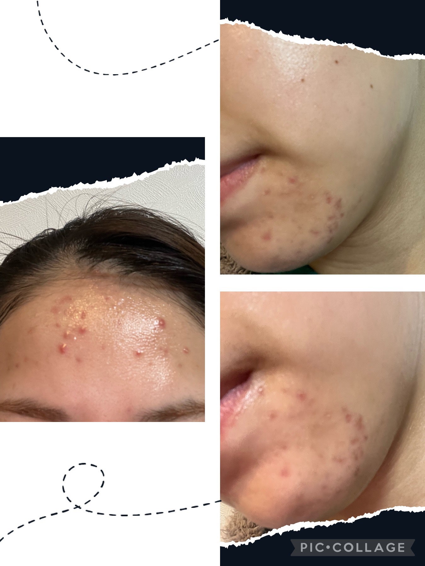 Pooh/フォロバ100◎ on LIPS 「〖肌荒れ経過報告🥲〗※肌荒れ写真が出てくるので苦手な人は見ない..」(4枚目)