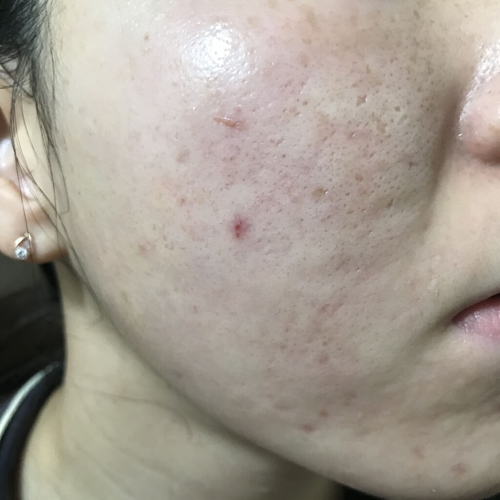 ゼロスポットパッチ/Today’s Cosme/にきびパッチを使ったクチコミ（1枚目）