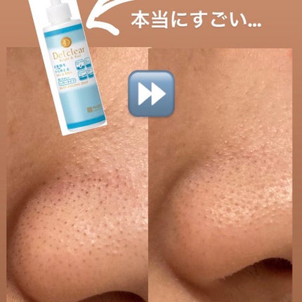 DETクリア ブライト&ピール ピーリングジェリー<無香料タイプ>/Detclear/ピーリングを使ったクチコミ(1枚目)