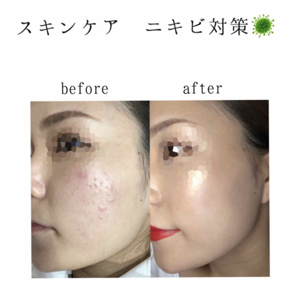 皮脂トラブルケア 化粧水/キュレル/化粧水を使ったクチコミ(1枚目)