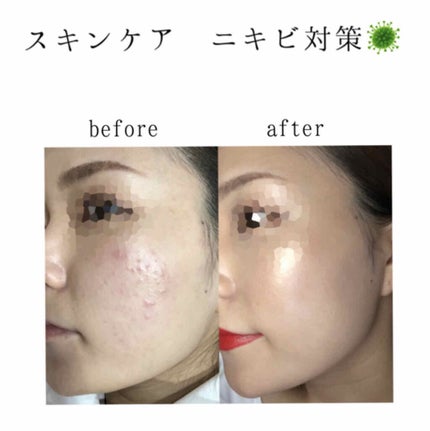 皮脂トラブルケア 化粧水/キュレル/化粧水を使ったクチコミ(1枚目)