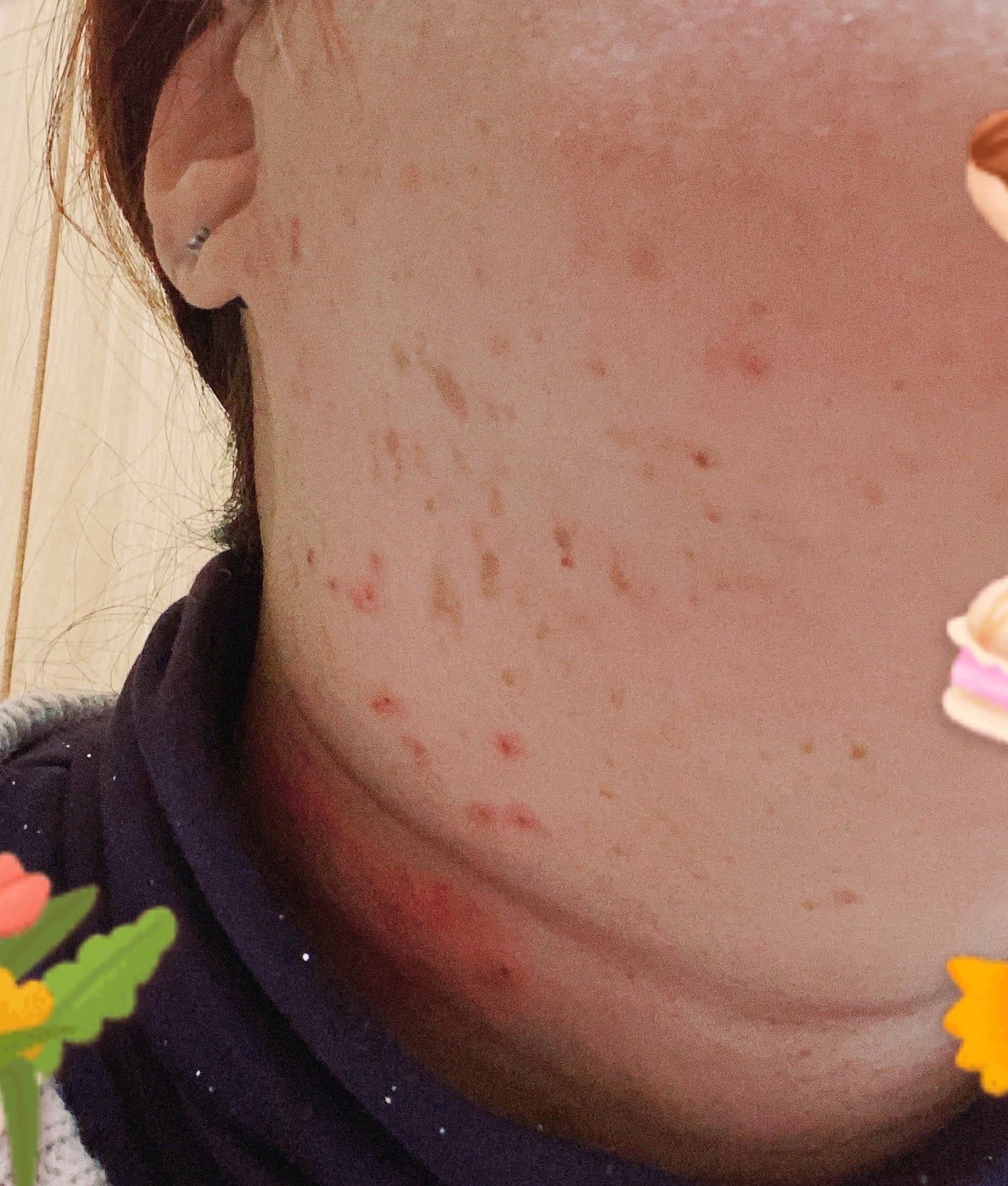 リサ・ラーソン♡クッションファンデマニア on LIPS 「#レーザー治療#シミ#アフターこれからしばらく塗り薬1週間程で..」(1枚目)