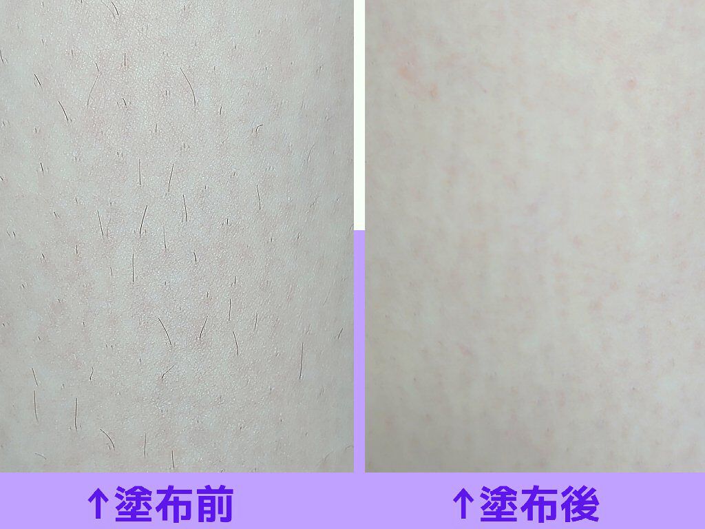 除毛クリームキット敏感肌用/エピラット/除毛クリームを使ったクチコミ(2枚目)