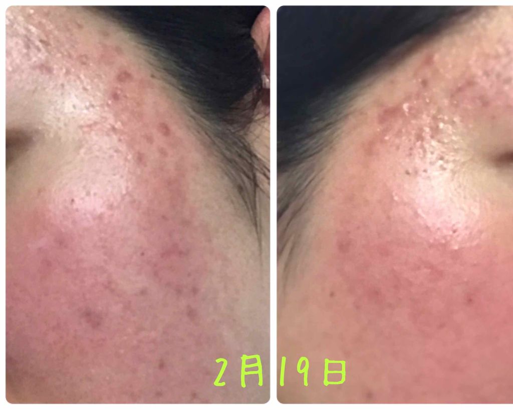 ハトムギ化粧水(ナチュリエ スキンコンディショナー R )/ナチュリエ/化粧水を使ったクチコミ(2枚目)