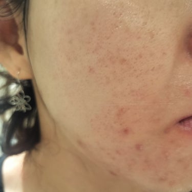 Glucolic Acid 30% Gel Peel/YEOUTH/ピーリングを使ったクチコミ（1枚目）