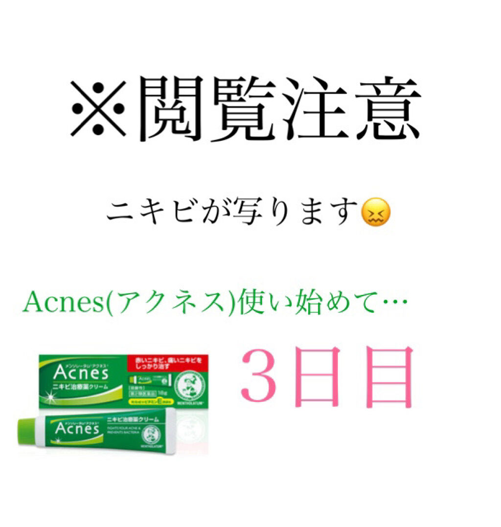 ニキビ治療薬(医薬品)/メンソレータム アクネス/その他を使ったクチコミ（1枚目）