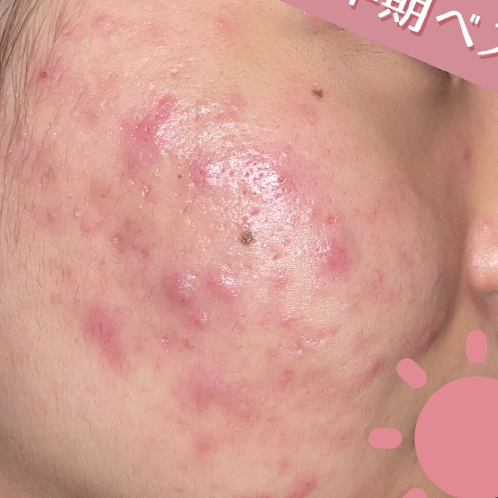 ビューティーケアマスク(ニキビ)/肌美精/シートマスク・パックを使ったクチコミ（3枚目）