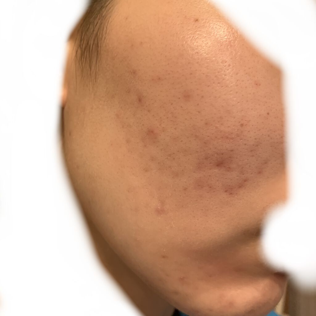 肌美精 大人のニキビ対策 薬用ホワイトクリア洗顔料のクチコミ「新しいニキビはあまり出てないよ

ちなみに洗顔は肌美精

このシリーズの化粧水、美白クリームも.....」（2枚目）