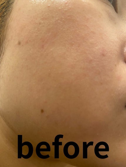 薬用 スキンケアファンデーション(パウダリー)/d プログラム/パウダーファンデーションを使ったクチコミ(5枚目)