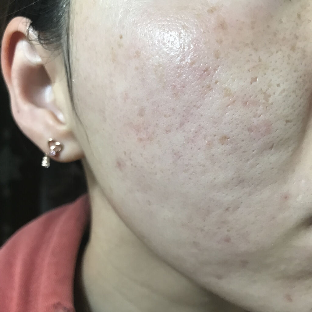 LA10+HAフェイスセラム/The Ordinary/ピーリングを使ったクチコミ（1枚目）