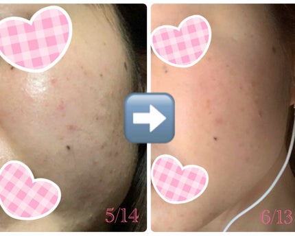 スキンピールバー ティートゥリー/サンソリット/洗顔石鹸を使ったクチコミ(3枚目)