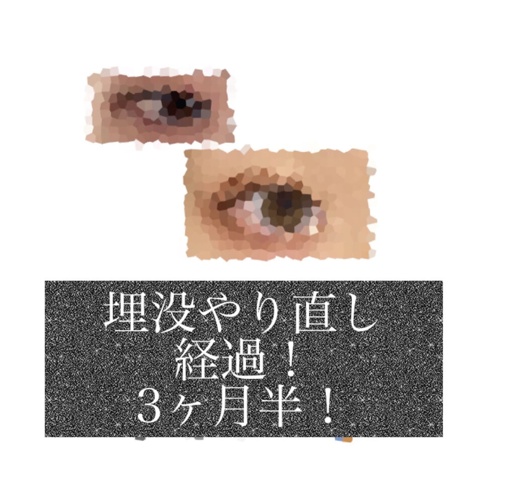 二重整形/その他を使ったクチコミ（1枚目）