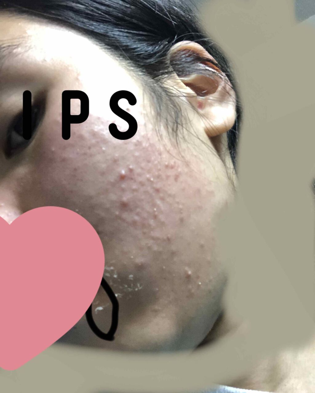 ベピオゲル/マルホ株式会社/その他を使ったクチコミ（2枚目）