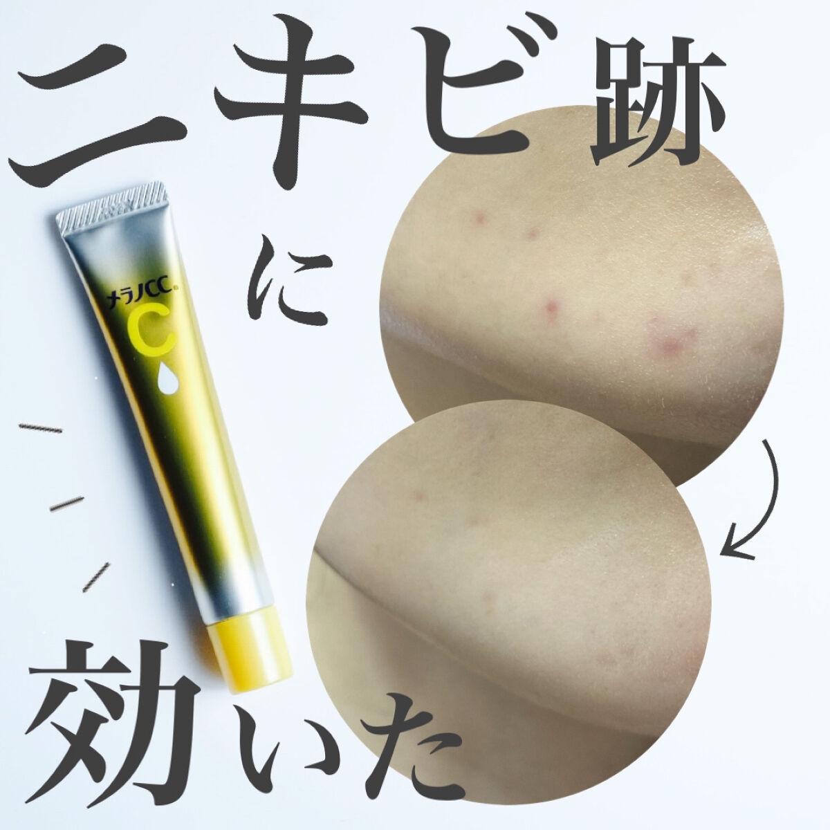 【いちばんニキビに効いた！！】

1年間治らなかったニキビ跡が
メラノCCを使ってかな〜り
薄くなりました🥹👏👏

今までコンシーラーで隠すのも
大変だったけど、
今ではコンシーラーいらず！

写真は約5ヶ月後のビフォーアフターだけど