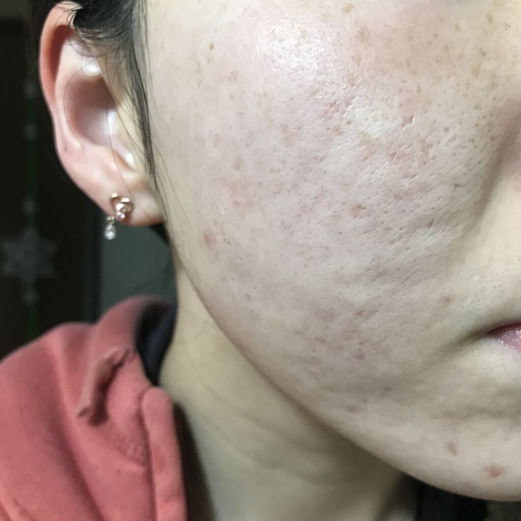 Amino Acid+B5/The Ordinary/美容液を使ったクチコミ（1枚目）