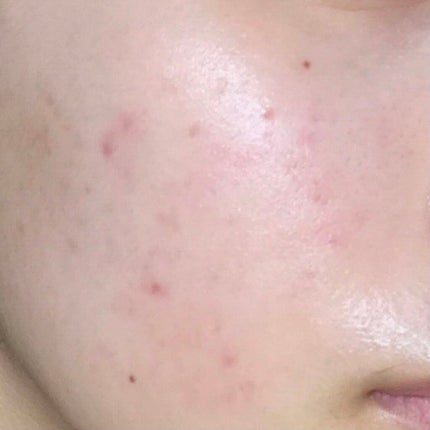 ビーソフテン ローション(医薬品)/持田製薬/その他を使ったクチコミ(2枚目)