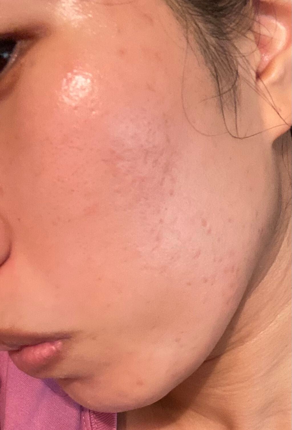 AKちゃん on LIPS 「ニキビが徐々にマシになっています。韓国の化粧品を使用し、1年ほ..」(1枚目)