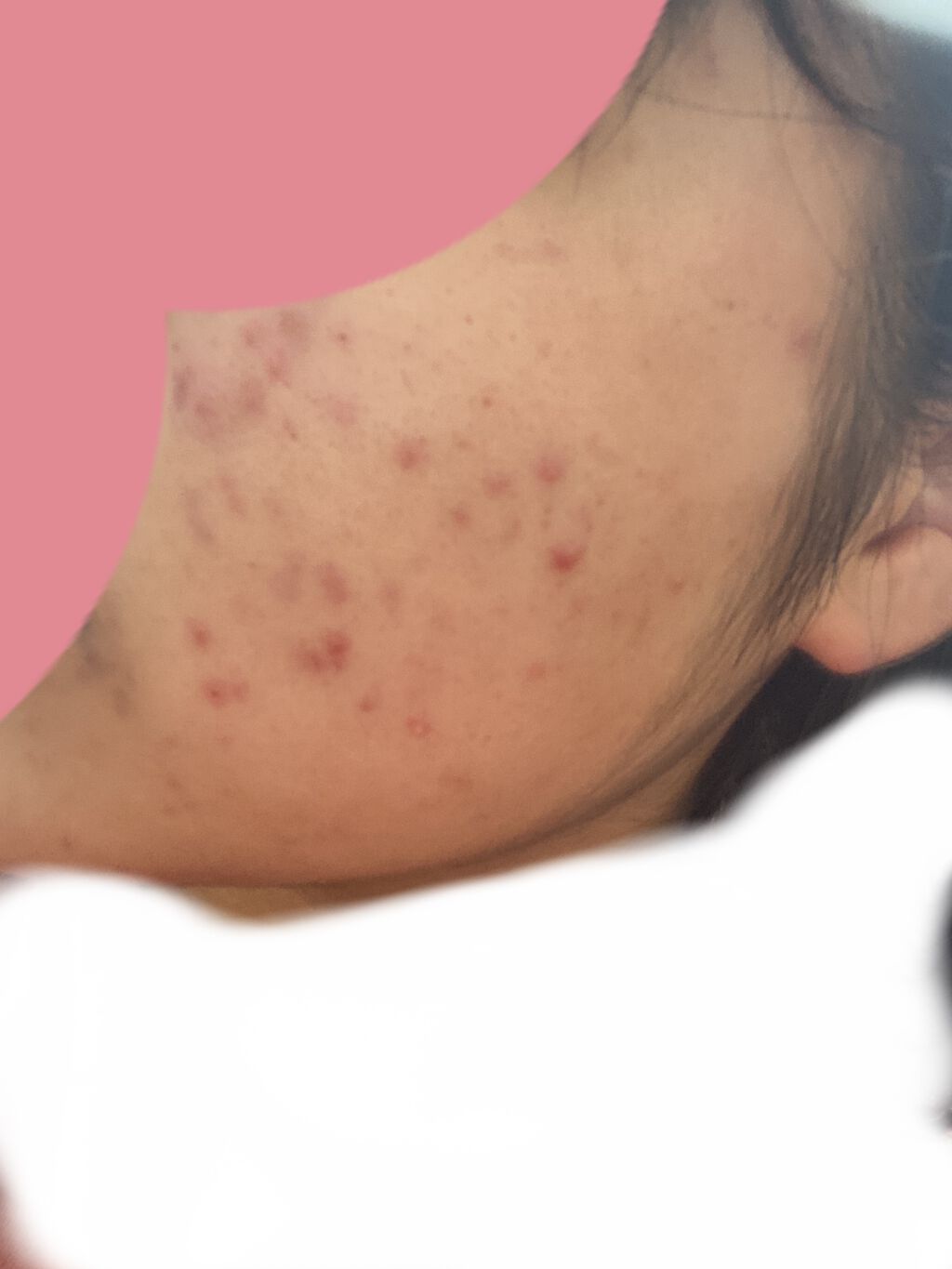 薬用ニキビケア ローション（思春期用）/アクネスラボ/化粧水を使ったクチコミ（2枚目）