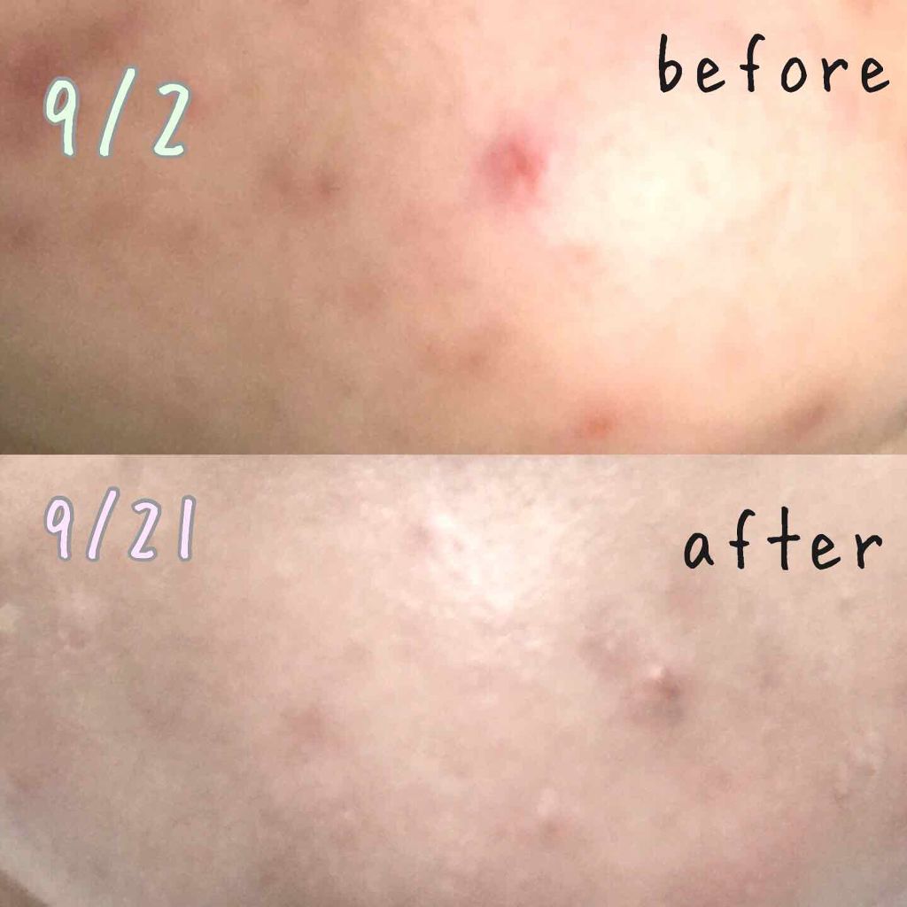 チョコラBBピュア (医薬品)/チョコラBB/その他を使ったクチコミ(2枚目)