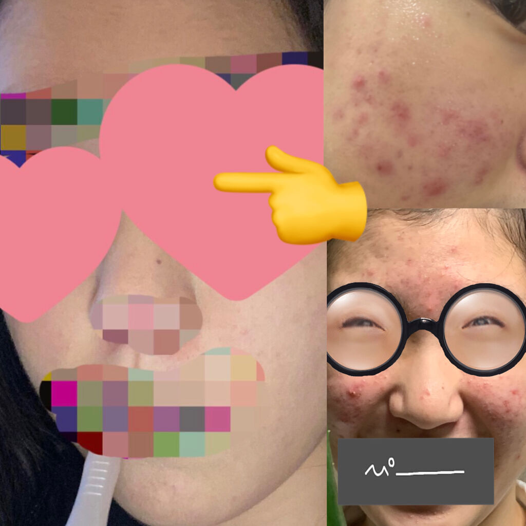 薬用洗顔フォーム/スキンライフ/洗顔フォームを使ったクチコミ（1枚目）