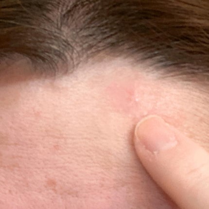 極薄透明パッチ nikipa!/金冠堂/にきびパッチを使ったクチコミ(8枚目)