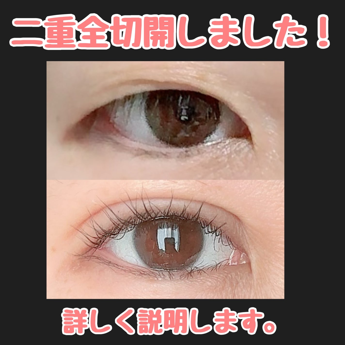 にゃみー★フォロバ投稿ある方 on LIPS 「【二重全切開+たるみ取りレポ】施術から2週間経ちました。今のと..」(1枚目)