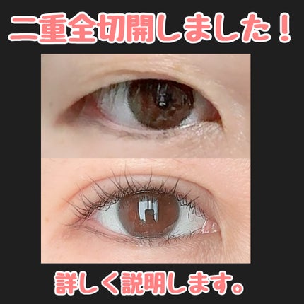 にゃみー★フォロバ投稿ある方 on LIPS 「【二重全切開+たるみ取りレポ】施術から2週間経ちました。今のと..」(1枚目)