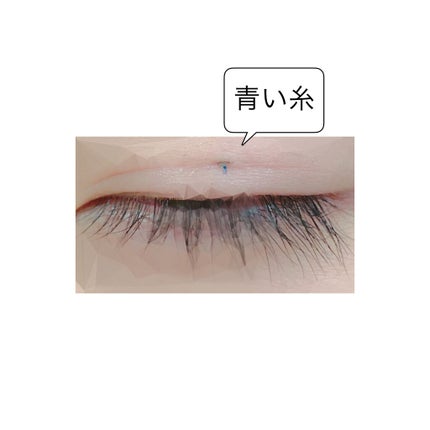 二重整形/その他を使ったクチコミ(3枚目)