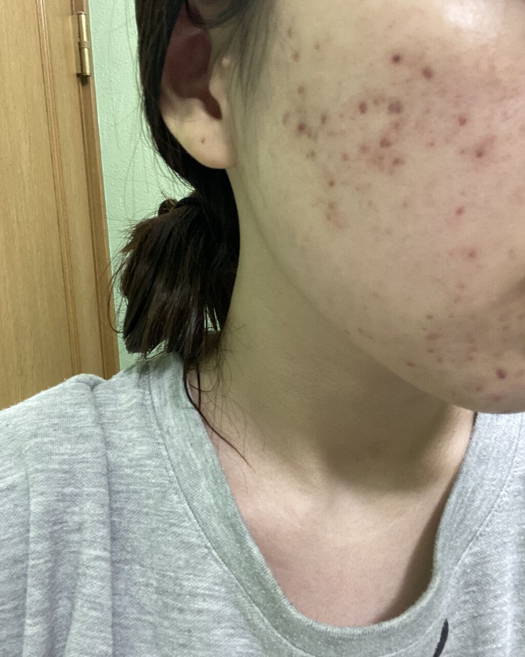 オロナインＨ軟膏 (医薬品)/オロナイン/その他を使ったクチコミ（2枚目）