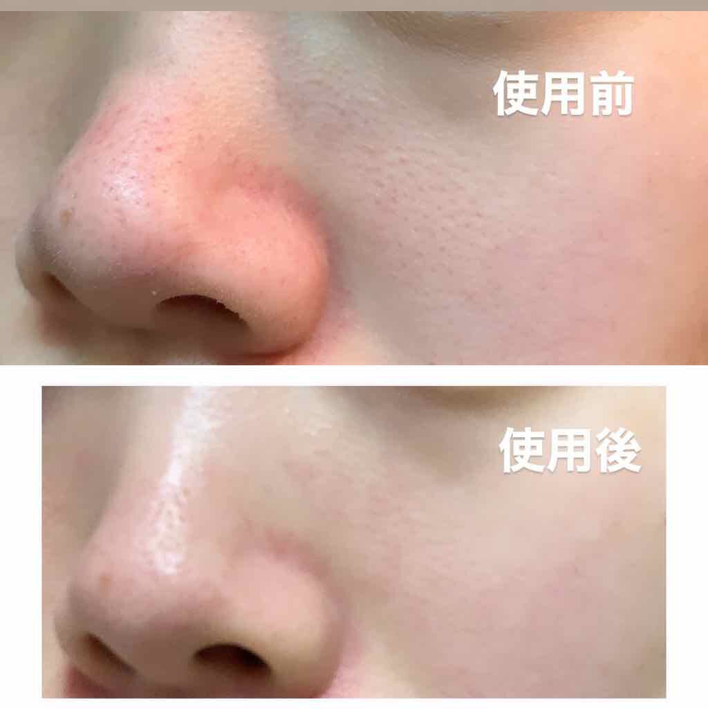 VCスーパー毛穴セラム/ラボラボ/美容液を使ったクチコミ（2枚目）