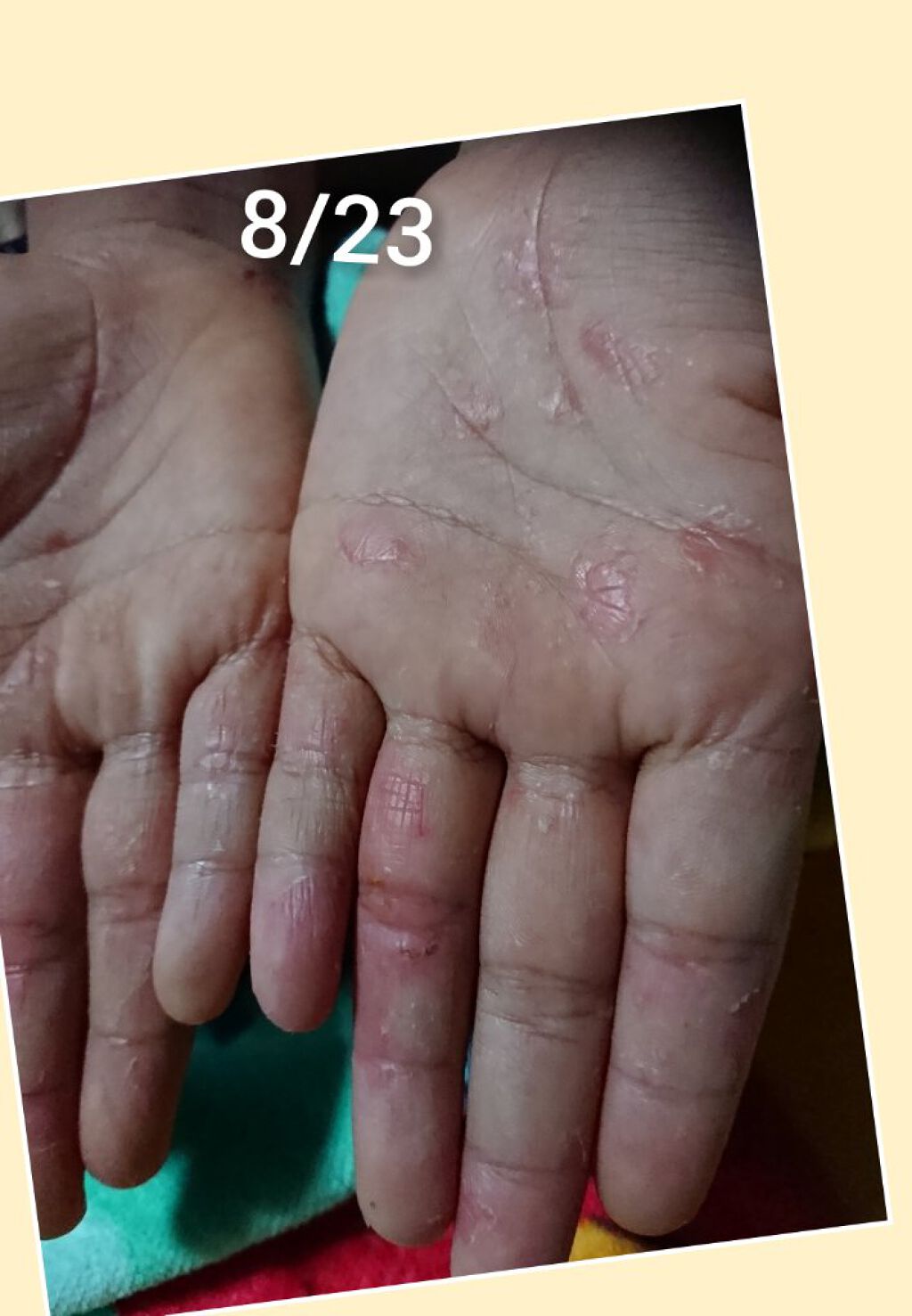 ❥ ❥ ❥ ru-ru-❥ ❥ ❥ on LIPS 「💥子供のとびひ💥ん…………せっかくいい感じだったのに😰💦雨が降..」(2枚目)