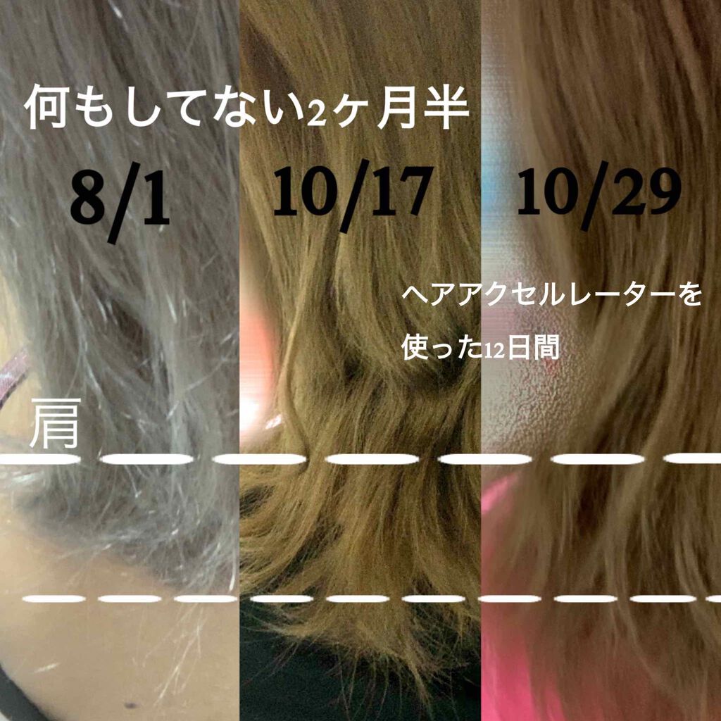 亜鉛 30日分 栄養機能食品 亜鉛 Dhcを使った口コミ ヘアアクセルレーター 亜鉛途中経過 8月の By なちょす 混合肌 代後半 Lips