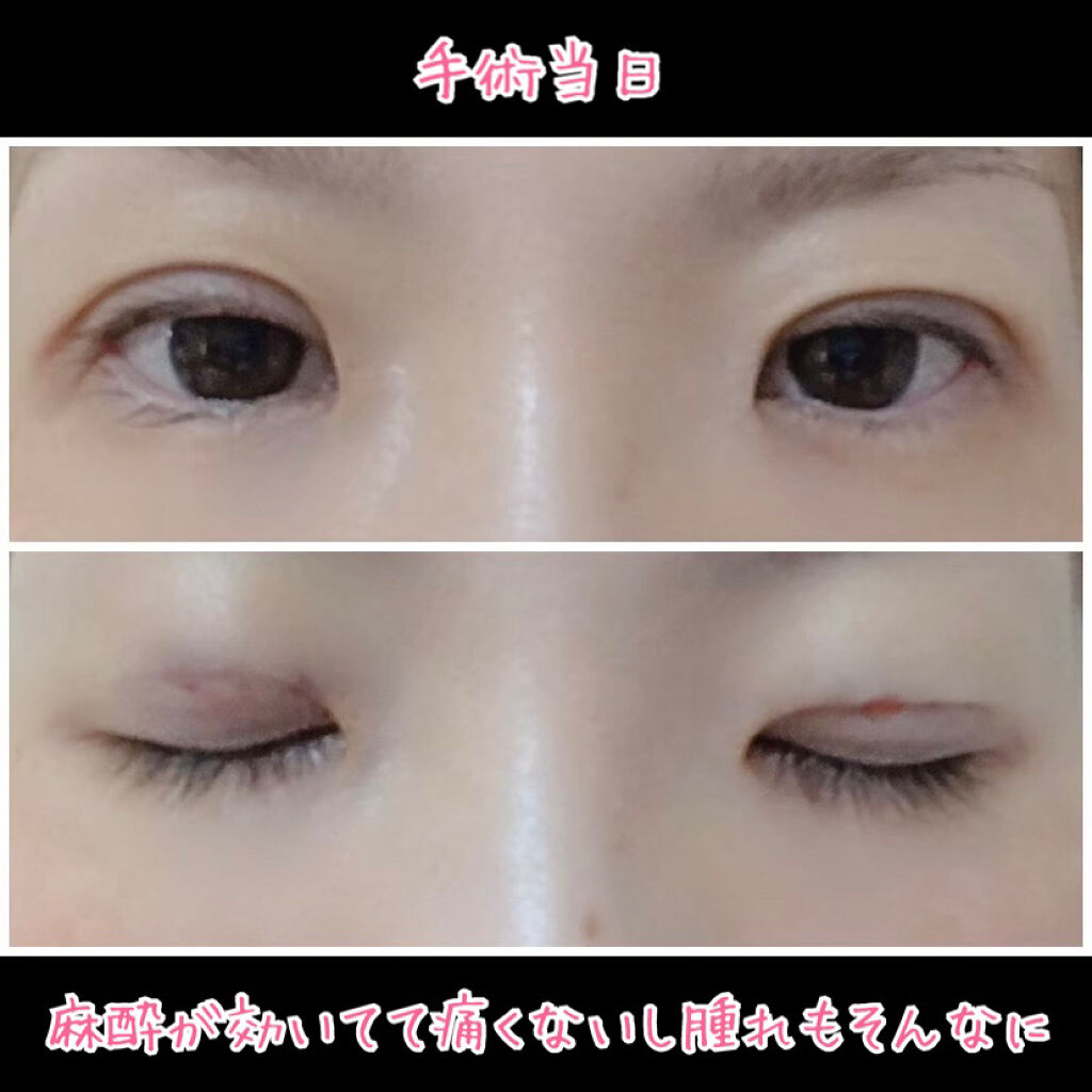 二重整形/その他を使ったクチコミ（2枚目）