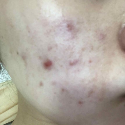 薬用しみ対策美白ジェル/メラノCC/フェイスクリームを使ったクチコミ(3枚目)