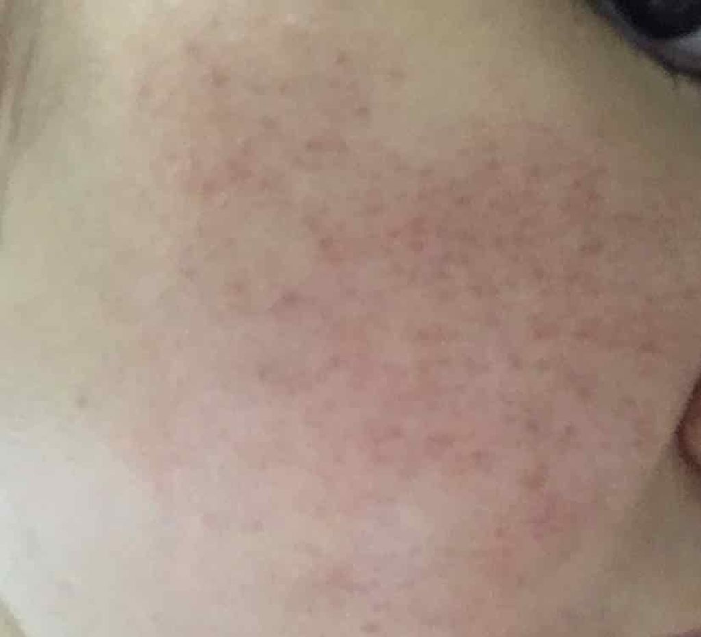 ぶたん on LIPS 「閲覧注意ニキビ跡が全然治る気配が無く毎日辛いです。皮膚科の薬を..」(1枚目)