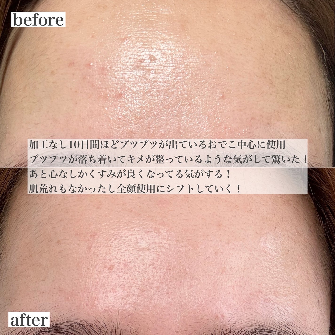 リードルショット300/VT/美容液を使ったクチコミ(8枚目)