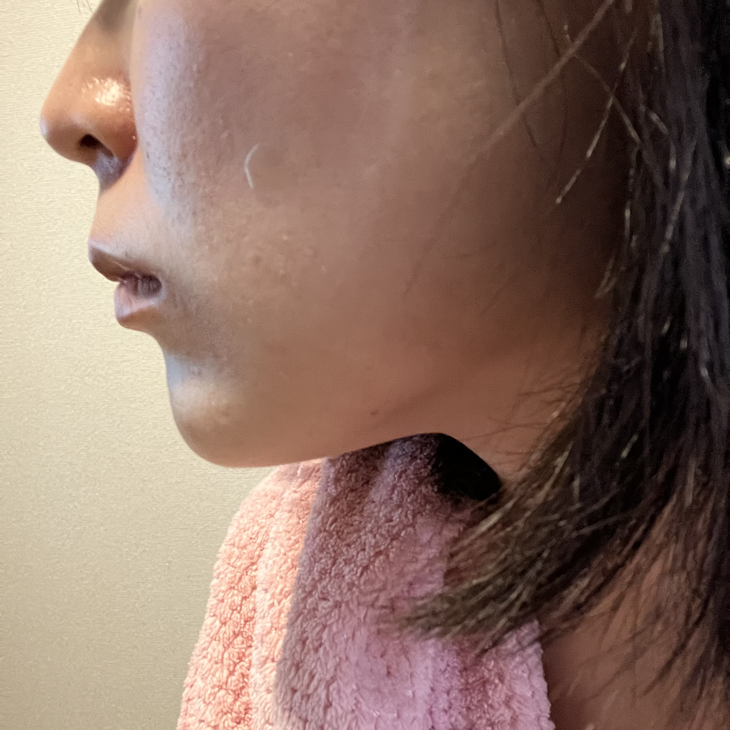 極薄透明パッチ nikipa!/金冠堂/にきびパッチを使ったクチコミ（3枚目）