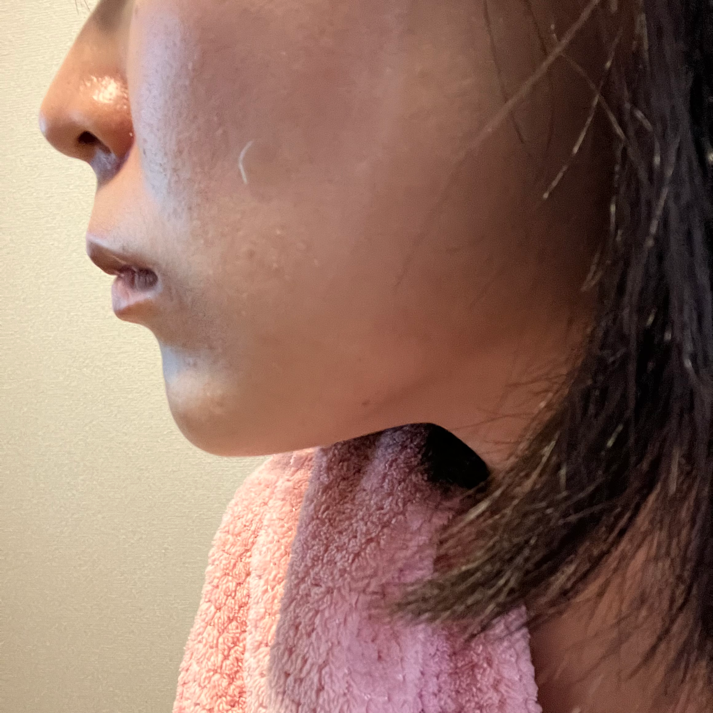 極薄透明パッチ nikipa!/金冠堂/にきびパッチを使ったクチコミ(3枚目)