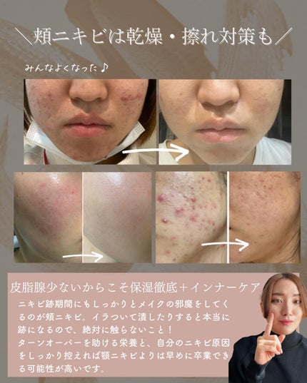 おゆみ|ニキビ・ニキビ跡ケア on LIPS 「【頬ニキビ原因MAP〜最も潰されてしまいがちなニキビ達〜】こん..」(5枚目)