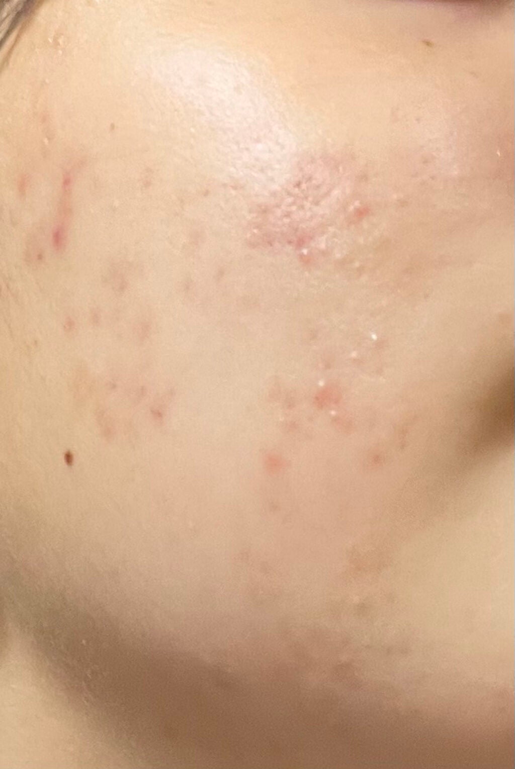 orange_beauty_6q68 on LIPS 「治癒の過程です。写真の向きが違いますが同じ側の頬です。治ってき..」(4枚目)