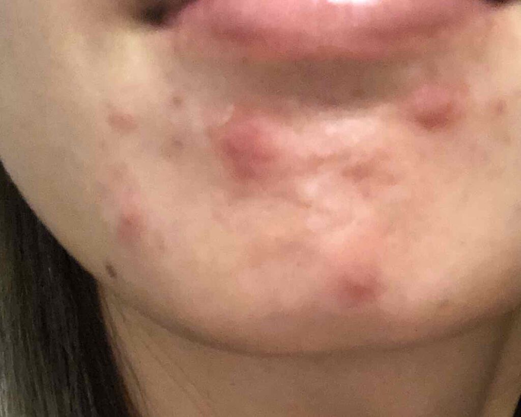 クリンダマイシン酸エステルゲル1%「サワイ」(医薬品)/sawai/その他を使ったクチコミ（2枚目）