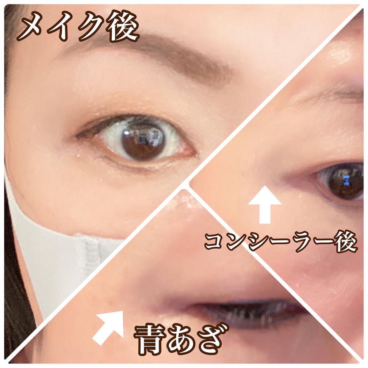 タトゥーウォータープルーフスカーコンシーラー/フォレンコス/リキッドコンシーラーを使ったクチコミ(5枚目)