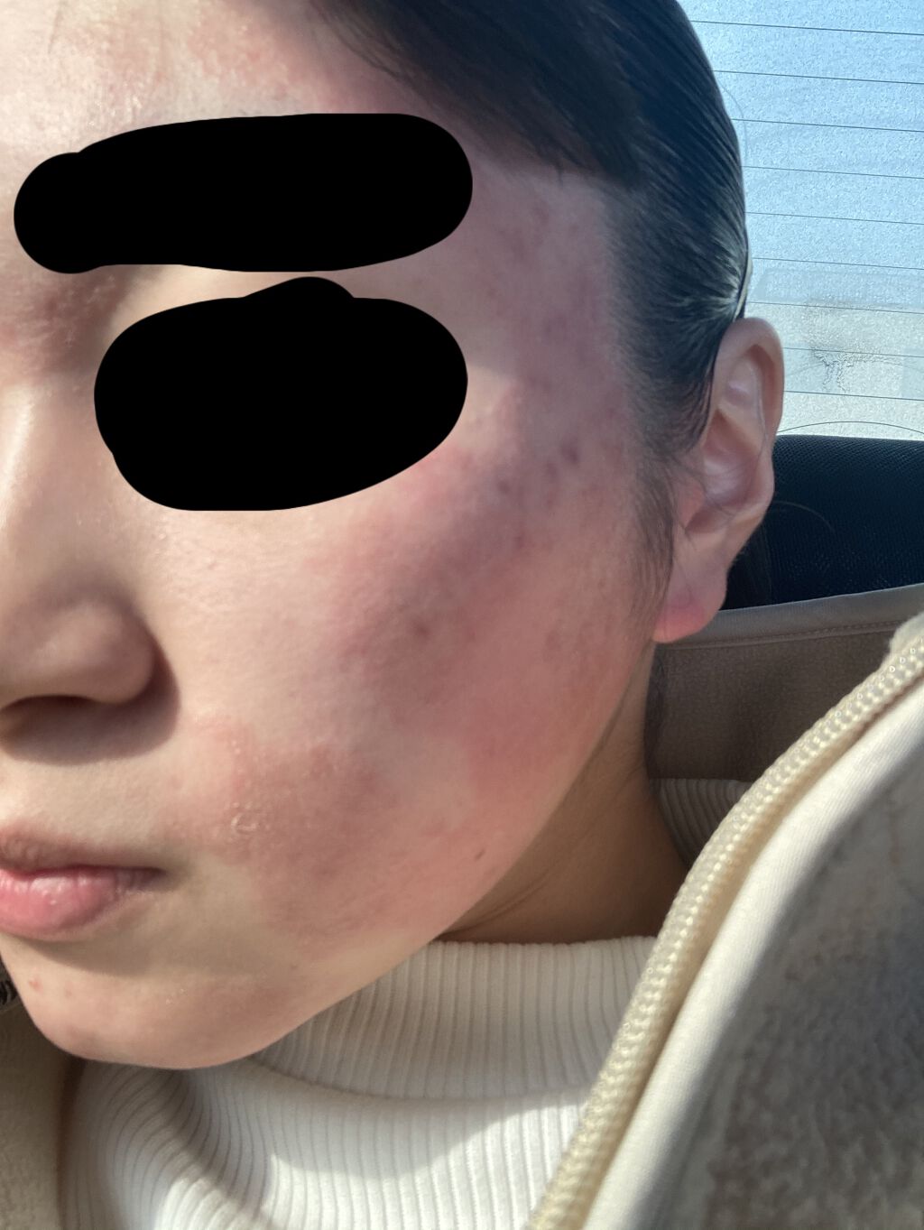 ベピオゲル/マルホ株式会社/その他を使ったクチコミ（1枚目）