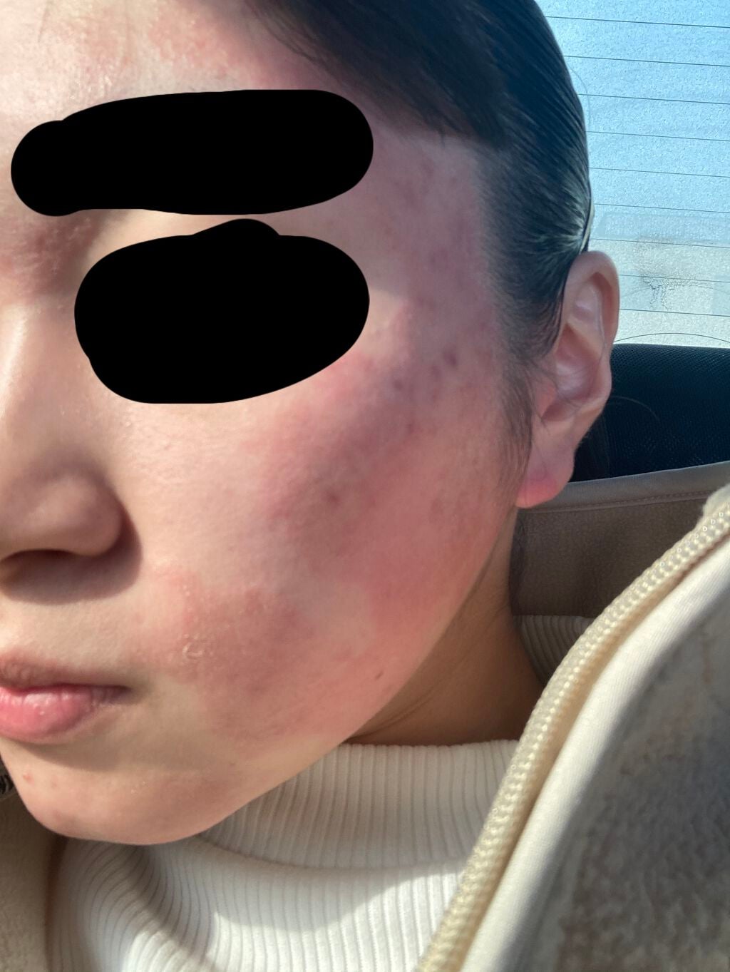 fantastic_make_9nly on LIPS 「ニキビ治療記録べピオゲル副作用..」(1枚目)