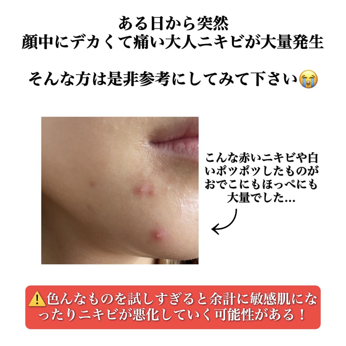 オードムーゲ 薬用ローション（ふきとり化粧水）/オードムーゲ/拭き取り化粧水を使ったクチコミ（2枚目）