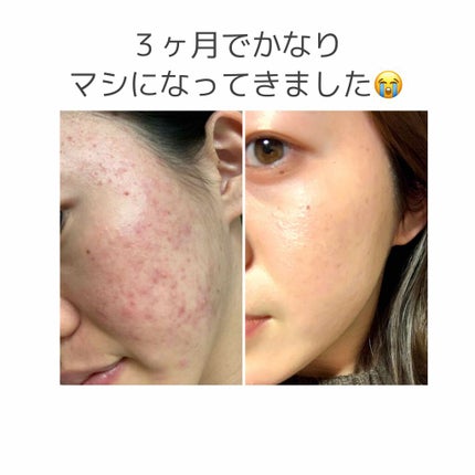 テラ・コートリル 軟膏(医薬品)/ジョンソン・エンド・ジョンソン/その他を使ったクチコミ(1枚目)