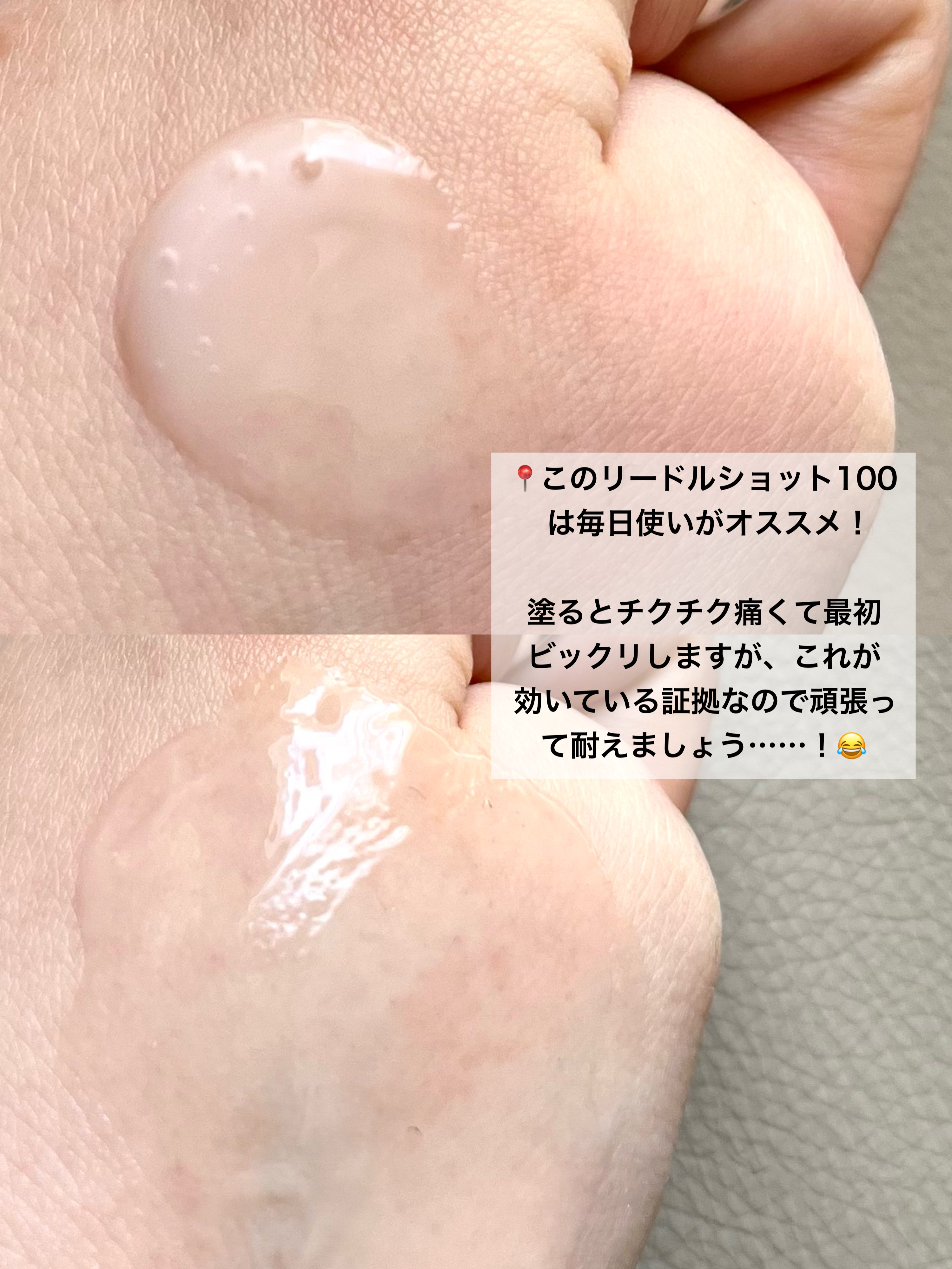 リードルショット100/VT/美容液を使ったクチコミ（3枚目）